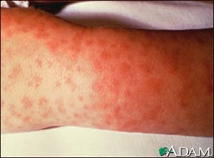 Rocky mountain spotted fever, lesions on arm