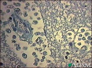 Amebic brain abscess