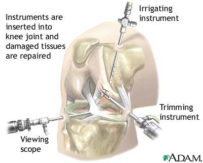 Arthroscopy Arthroscopy