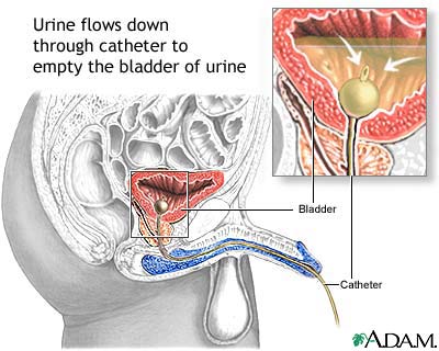 Bladder catheterization, male