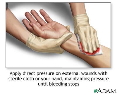 Stopping bleeding with direct pressure