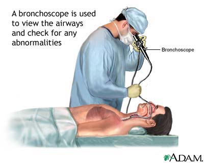 Bronchoscopy Bronchoscopy