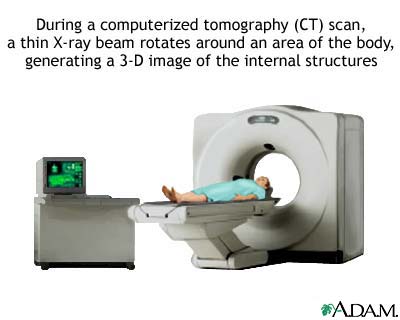 CT scan CT scan