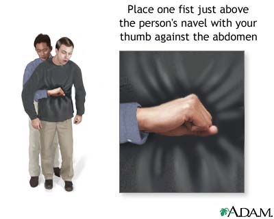 Heimlich maneuver on adult Heimlich maneuver on adult