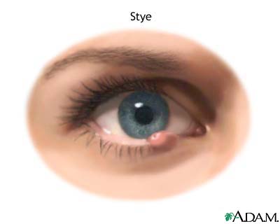 Stye Stye
