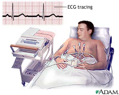 ECG ECG
