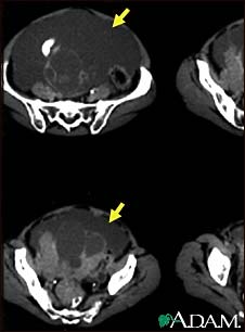 Ascites with ovarian cancer, CT scan Ascites with ovarian cancer, CT scan