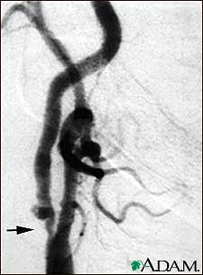 Carotid stenosis, X-ray of the right artery