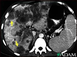 Hepatocellular cancer, CT scan Hepatocellular cancer, CT scan