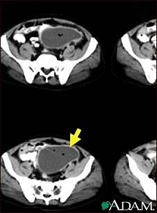 Intra-abdominal abscess, CT scan