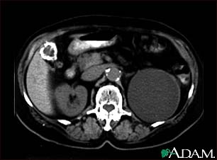 Kidney cyst with gallstones, CT scan Kidney cyst with gallstones, CT scan