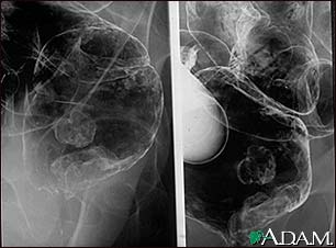 Rectal cancer, X-ray