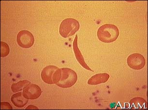 Red blood cells, sickle cell