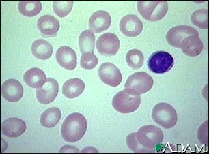 Megaloblastic anemia - view of red blood cells