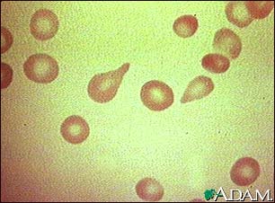 Red blood cells, tear-drop shape Red blood cells, tear-drop shape