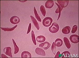 Red blood cells, multiple sickle cells