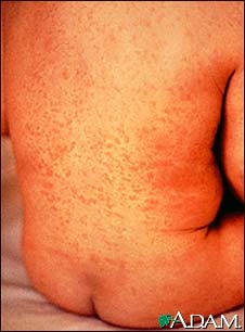 Rubella on an infant's back Rubella on an infant's back