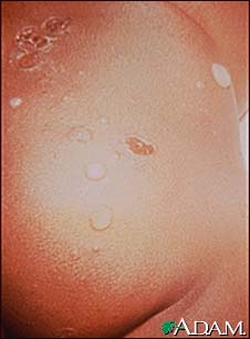 Impetigo, bullous on the buttocks Impetigo, bullous on the buttocks