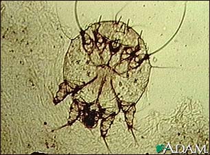 Scabies mite, photomicrograph