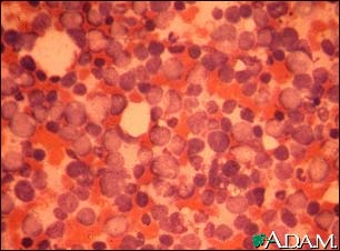 Chronic myelocytic leukemia Chronic myelocytic leukemia