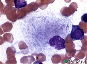 Gaucher cell, photomicrograph Gaucher cell, photomicrograph