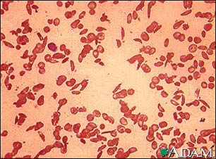 Red blood cells, sickle cells Red blood cells, sickle cells