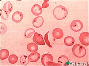 Red blood cells, sickle and pappenheimer Red blood cells, sickle and pappenheimer