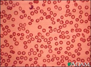 Thalassemia minor Thalassemia minor