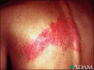 Herpes zoster (shingles) on the back