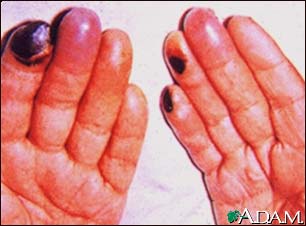 Cryoglobulinemia - of the fingers Cryoglobulinemia - of the fingers