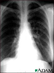Coccidioidomycosis - chest X-ray Coccidioidomycosis - chest X-ray