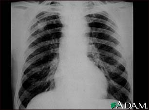 Coal workers pneumoconiosis - stage II #2 Coal workers pneumoconiosis - stage II #2