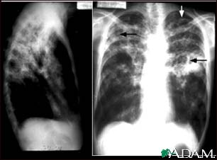 Tuberculosis, advanced - chest X-rays Tuberculosis, advanced - chest X-rays