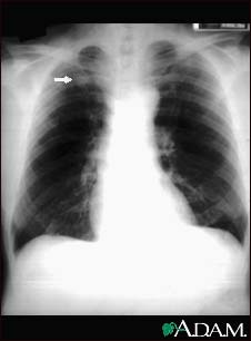 Pulmonary nodule - front view chest X-ray Pulmonary nodule - front view chest X-ray