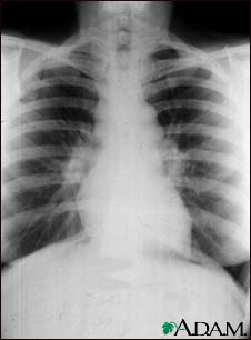 Sarcoid, stage I - chest X-ray