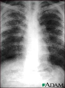 Sarcoid, stage II - chest X-ray