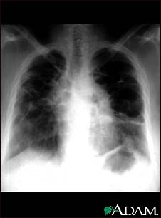 Sarcoid, stage IV - chest X-ray