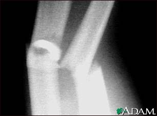 Fracture, forearm - X-ray Fracture, forearm - X-ray