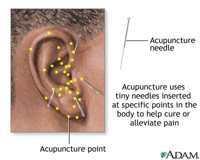 Acupuncture