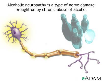 Alcoholic neuropathy Alcoholic neuropathy