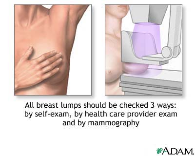 Breast lumps