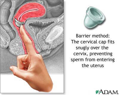 The cervical cap The cervical cap