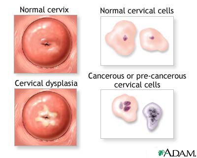 Cervical neoplasia