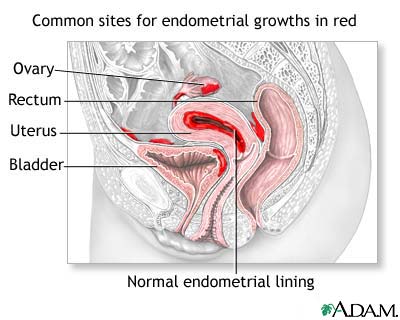 Endometriosis