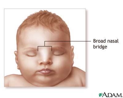 Broad nasal bridge