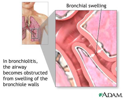 Bronchiolitis Bronchiolitis