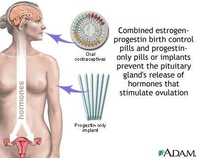 Hormone-based contraceptives Hormone-based contraceptives