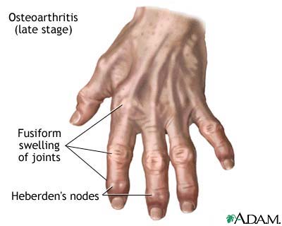 Osteoarthritis Osteoarthritis