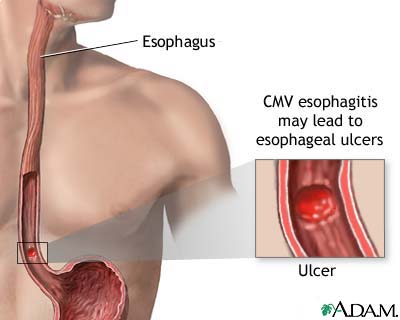 CMV esophagitis CMV esophagitis