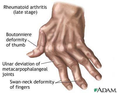 Rheumatoid arthritis Rheumatoid arthritis